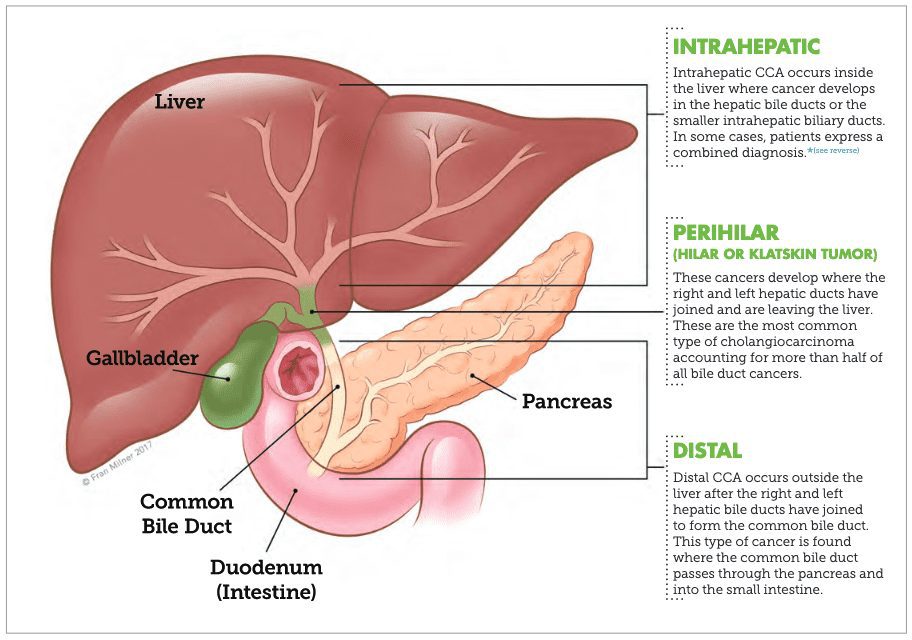 What are the different types of cholangiocarcinoma - a cancer of the bile ducts